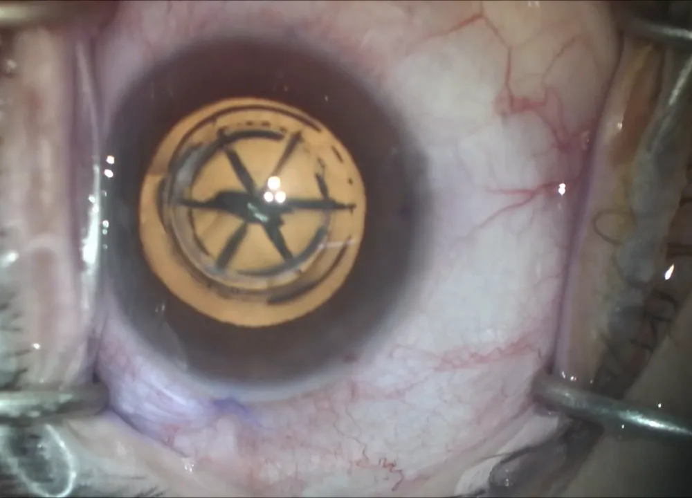 The laser-cut capsulotomy and softened, segmented cataract during surgery