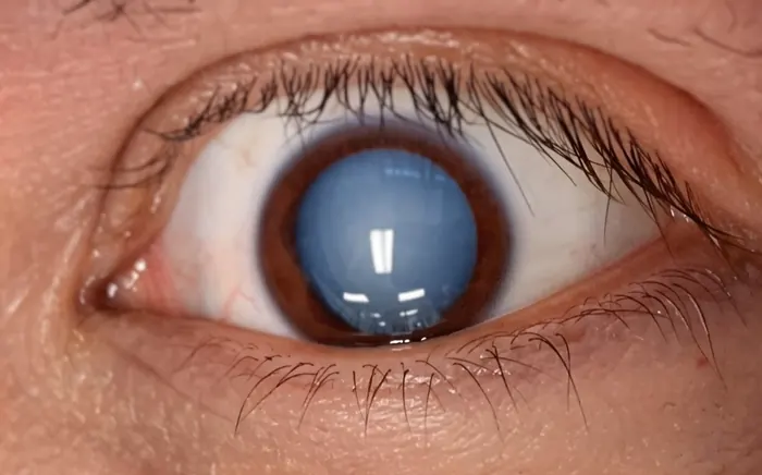 A dense, mature cataract before surgery